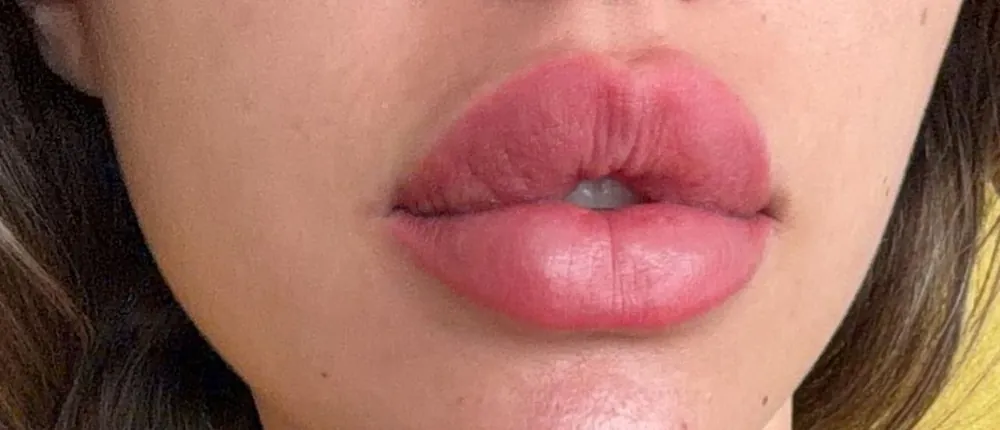 Healed lip blush result
