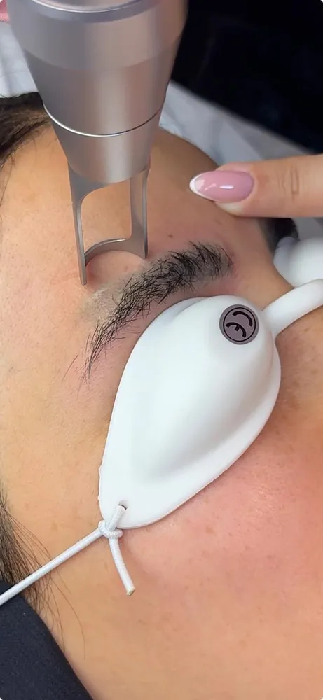 Laser tattoo and PMU removal at Batoul Beauty