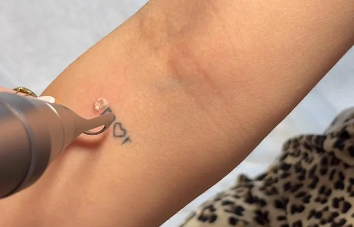 Laser tattoo removal with PicoWay